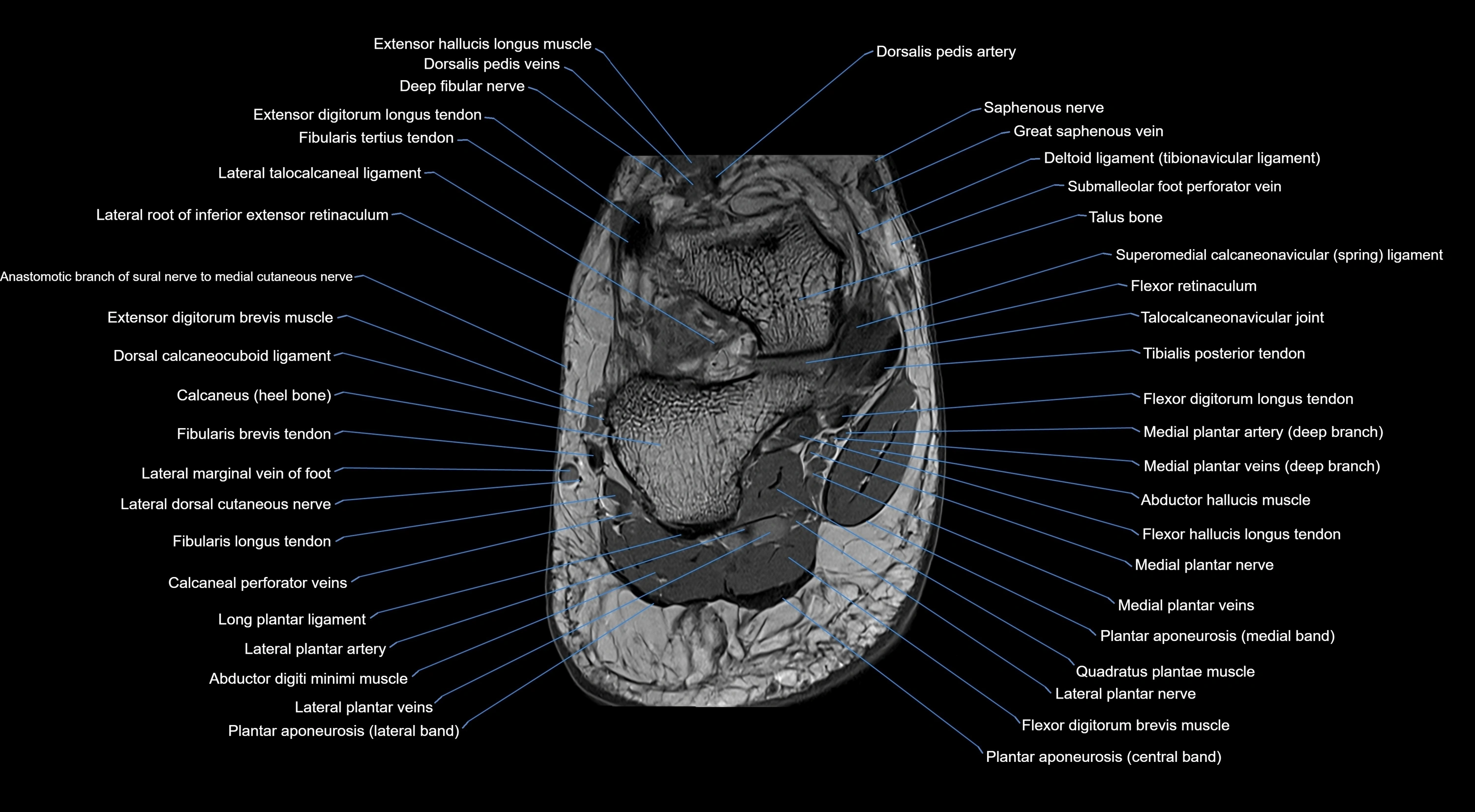 MRI mid foot coronal ligaments cross sectional anatomy 3T  radiology  image-img-00001-00042.webp
